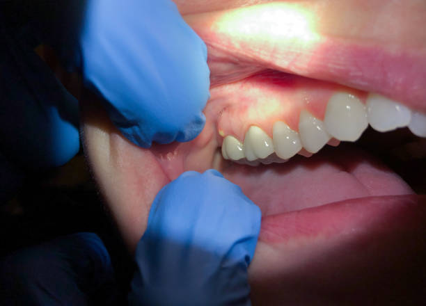 Best Tooth Infection Emergency Dentist  in Ross, OH